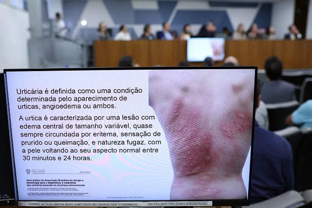 Comissão de Saúde - debate sobre a urticária crônica no Estado